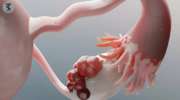 Understanding Ovarian Cysts